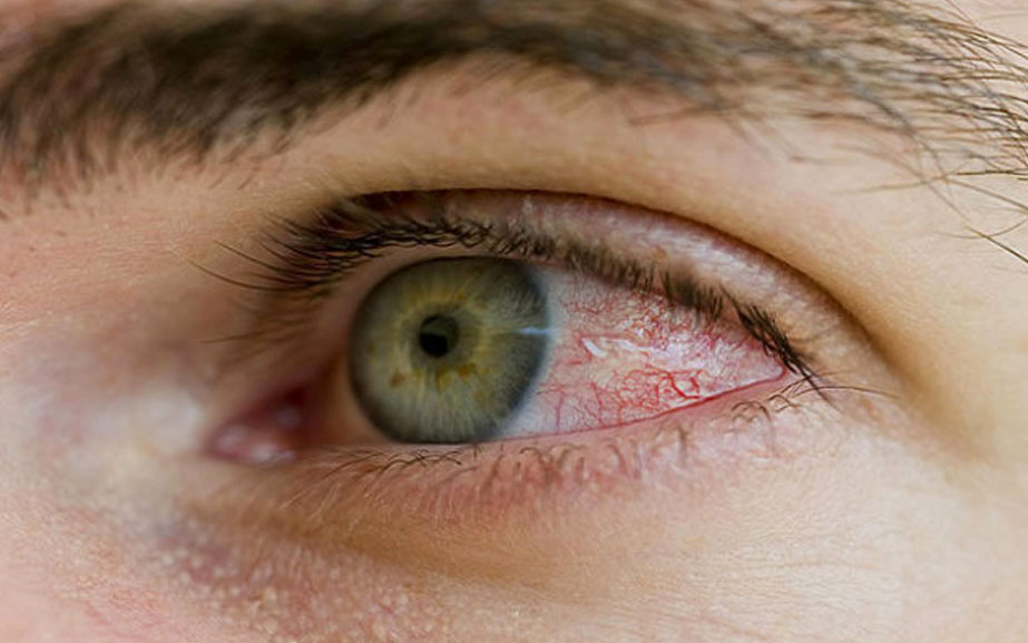 Diyabetik Retinopati