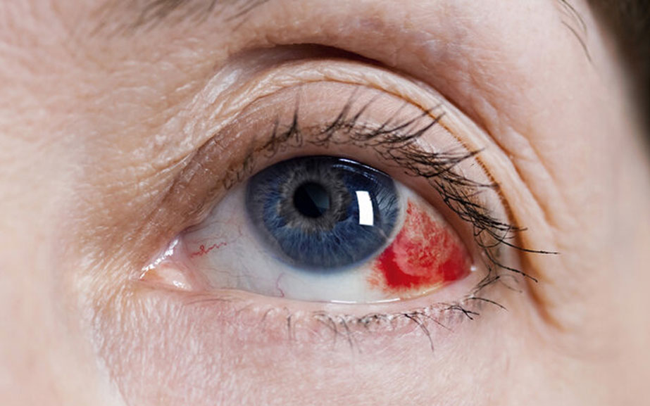 Göz Tansiyonu (Glokom)