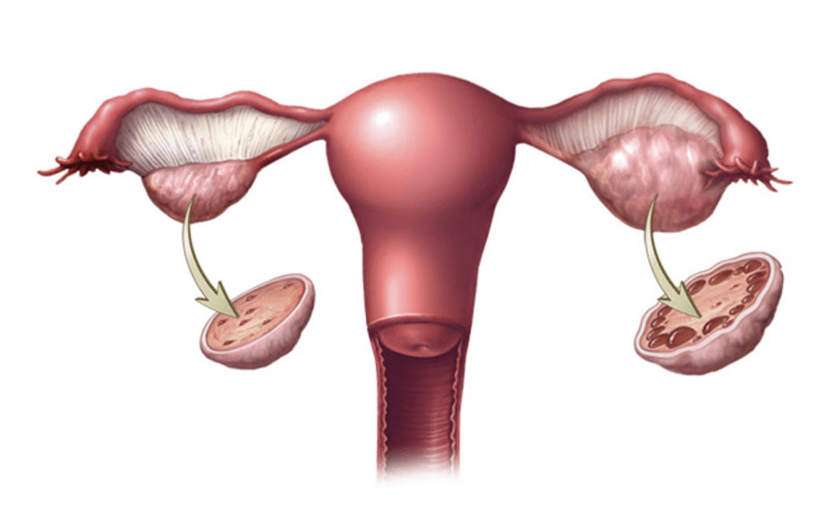 Polikistik Over (PCOS)
