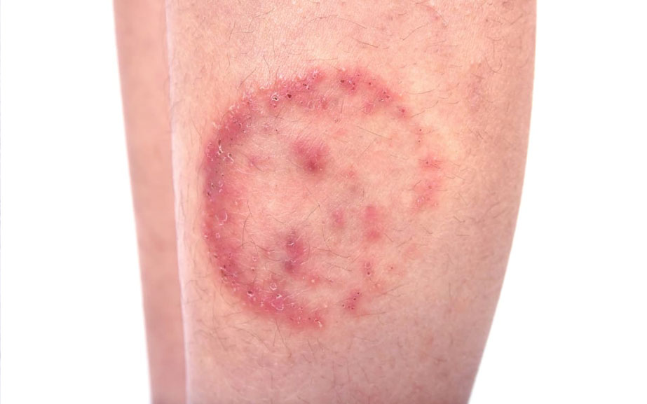 Mantar enfeksiyonları