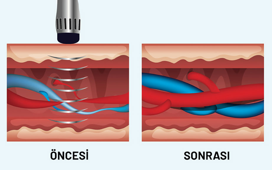 ESWT Şok Dalga Tedavisi