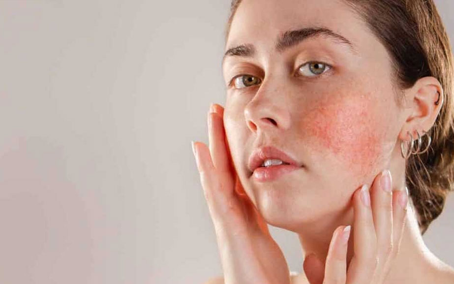 Rosacea (Gül Hastalığı)