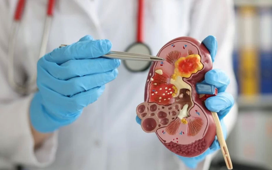 Lazerle Böbrek Taşı Ameliyatları